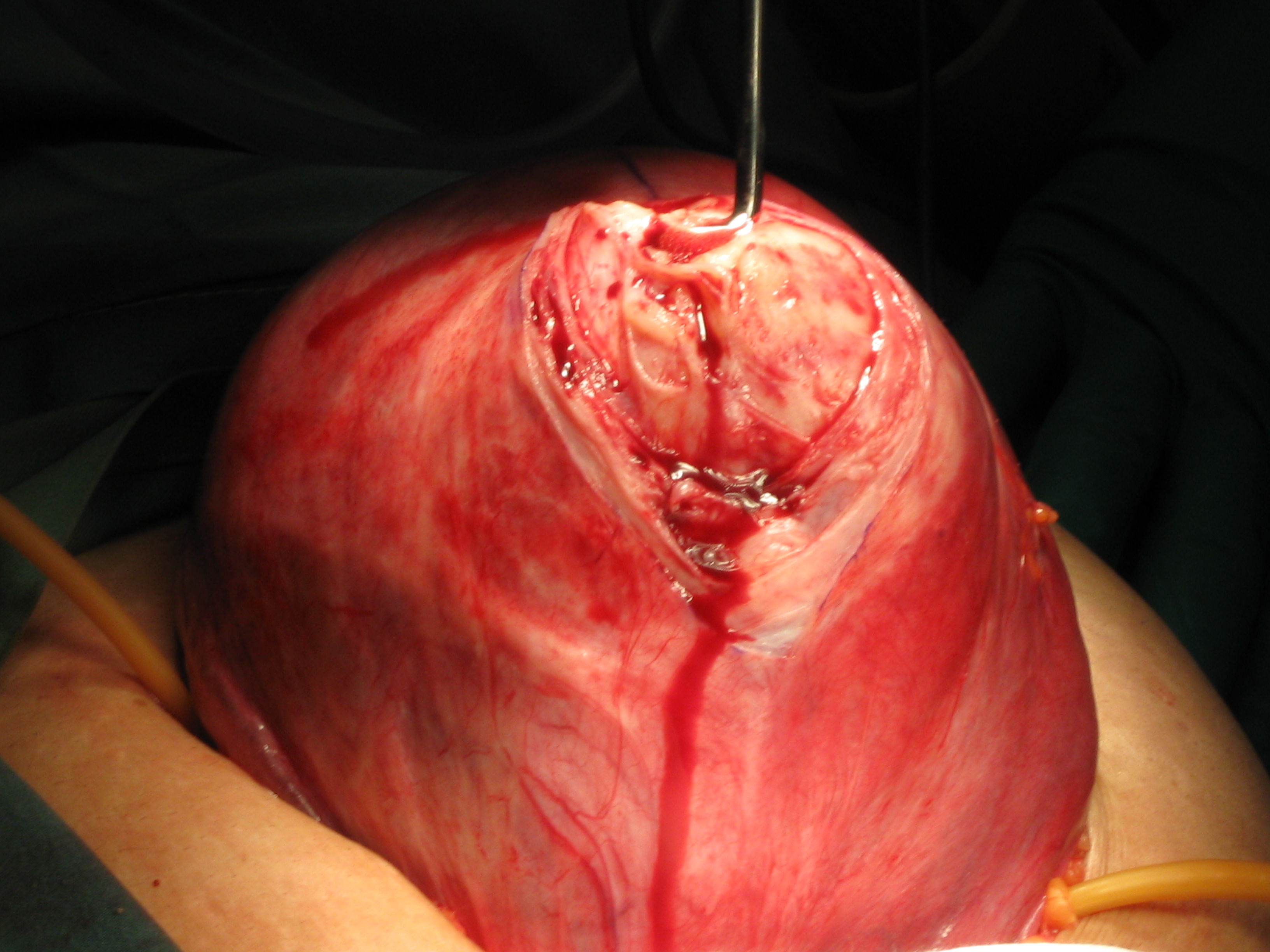 Myomectomy Fibroid Abdominal Serag Youssif (8)